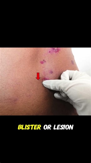 🔬 Nikolsky Sign Explained: Blistering Skin #dermatology #medicine #emergencymedicine #meded