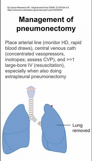 Management of pneumonectomy