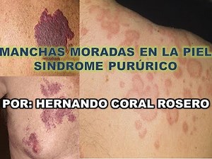 MANCHAS MORADAS EN LA PIEL