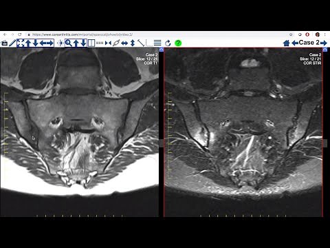 MRI lesions in the sacroiliac joints of patients with spondyloarthritis