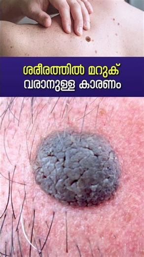ശരീരത്തിൽ മറുക് വരാനുള്ള കാരണം | The reason for moles on the body | Health Tips | Skin Care