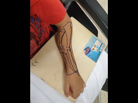 Pediatric Radius -Ulna Diaphysis Fracture (Closed Reduction Technique)