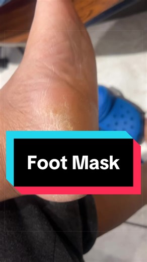 A total game changer!!! No need to be embarrassed & hide those ruff feet anymore! This simple foot mask eliminates all that dead skin at the bottom of your feet & makes your feet smooth again. 🦶🏼#feet #footmask #foot #beforeandafter