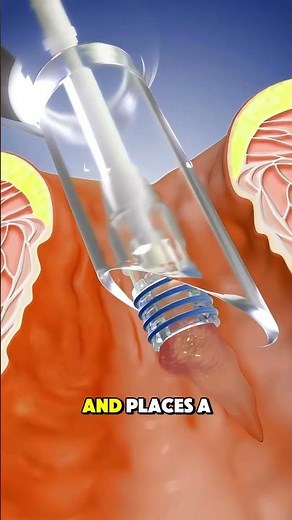 Rubber Band Ligation 3D Animation)#pilesremoval #medical3d #3danimation #medicalanimation #fyp