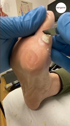 Podiatrist treats wart with acid