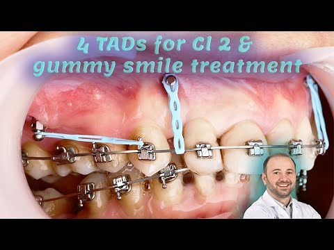 gummy smile & Cl 2 treatment using IZC & frontal TADs, Mini screw insertion power chain installation