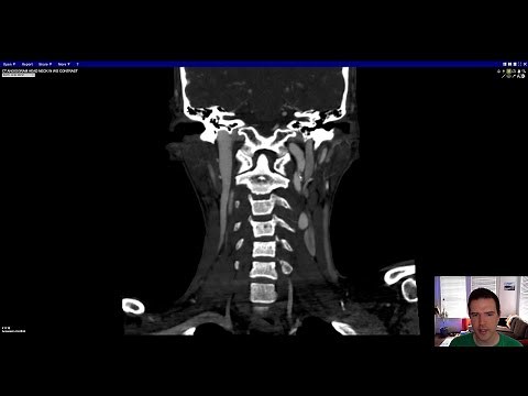 Vascular Imaging of the Head and Neck - Case D