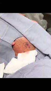 A PEPINO CYST - REMOVING A CYST ON THE CHIN