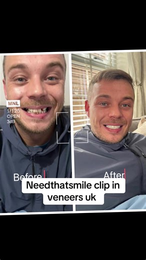vince198912 Over the moon Thankyou for giveing my life back Nts CUSTOMER IS WEARING standard SHADE BL3 Shop now www.needthatsmile.co.uk MISSING TEETH WE CAN HELP ?😄 • STANDARD TOP & BOTTOM NOW ONLY £199 • SUPER THINS TOP AND BOTTOM NOW ONLY £300 LIMITED TIME ONLY • SHOP NOW www.needthatsmile.co.uk ❌IF YOU HAVE ANY QUERIES OR WANT TO ORDER PLEASE MESSAGE OUR TEAM VIA WHATS APP ON 07961180002 OR SEE THE LINK IN OUR BIO SO THAT WE CAN HELP YOU FURTHER OR CLICK THE LINK IN OUR BIO OPENING HOURS MON