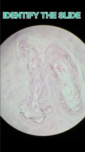 PATHOLOGY SLIDE : calcinosis cutis