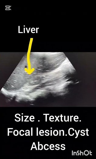 Ultrasound abdomen!Liver!!How to Perform Ultrasound Abdomen!#ultrasoundmadeeasy86#radiology#liver!