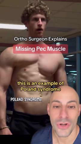 David Abbasi, MD | Orthopedic Sports Surgeon on Instagram: "Poland Syndrome is thought to be a result of abnormal subclavian vessel formation during embryonic formation. Either way… This dude is jacked! Bravo!👏 😷✅Follow @drdavidabbasi for More Daily Medical Content & Health Tips! #polandsyndrome #orthopedics #medical #drabbasi #chestday #gymtok #gym #pectuscarinatum #pectusescavatum"