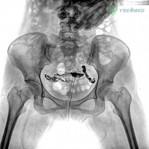 Share some dynamic images by YSX-RF65 65kW digital radiography and fluoroscopy system.