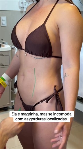 Com a lipo conseguimos tirar essas gorduras localizadas! Lembrando que cirurgia estética NÃO é brincadeira e não é para qualquer pessoa. Toda cirurgia envolve riscos. Por isso, precisa ser feita em hospital, com equipe especializada e após avaliação médica criteriosa. Lipoescultura não substitui hábitos saudáveis, não é para emagrecimento e não é um