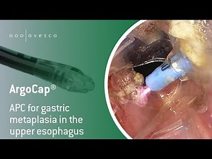 ArgoCap® | APC for gastric metaplasia in the upper esophagus