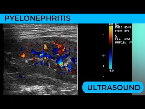 Pylenonephritis on ultrasound ,what to look for ?