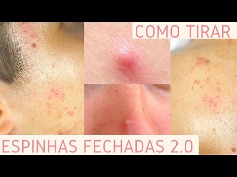 HOW TO REMOVE INTERNAL AND EXTERNAL PIMPLES 20 - Bruna Harmel
