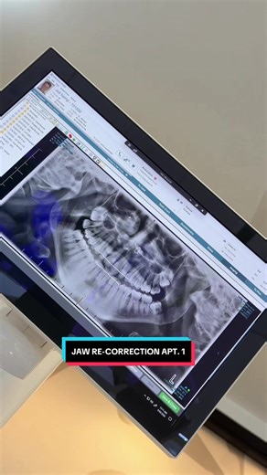 Braces Back On: Underbite Correction Journey