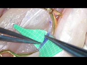 Chicken Wing Dissection (2) : SUA-UV Anastomosis