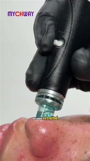 20 mins deep cleansing, why are my blackheads still staring at me?
