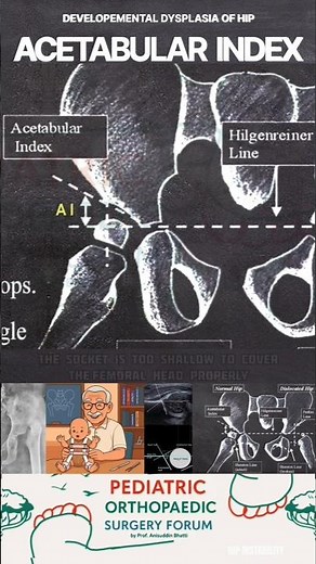 ACETABULAR INDEX EXPLAINED #ddh #hip #ortho #doctor #radiology #explained #howto