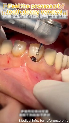 Watch how tooth decay is removed step by step to restore a healthy smile! #ToothDecay #ToothDecayRemoval #DentalCare #HealthyTeeth #CavityTreatment #OralHealth #Dentist #ToothRestoration #DentalHygiene #Teeth