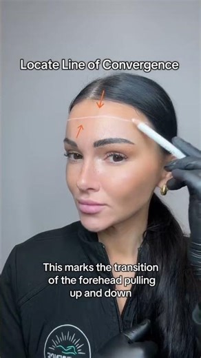 Forehead Botox Depth