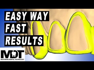 Exocad 3.1 Easy Window Crown cutting Technique in step by step Dental Technician Design Tutorial