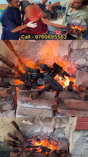 “Agnikarma Treatment LIVE 🔥 Lower Back Pain Ka Asli Ayurvedic Ilaaj’’ | Sushrutam Hospital
