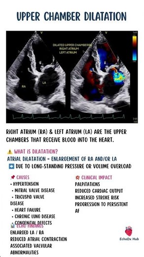 Upper Chamber Dilatation #EchoDxHub #AtrialDilatation #EchoBasics #Cardiology #CardiacImaging