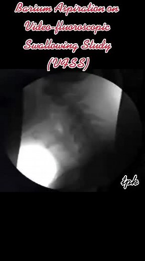 ‏Barium Aspiration on Video-fluoroscopic Swallowing Study (VFSS)