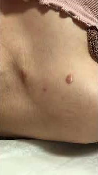 How to do Keloid Injection for Hypertropic Scars