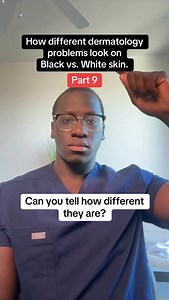 Episode 9 of Derm on Darker Skin! Skin changes can be easy to miss if you don’t know what you’re looking for. In this episode, let’s look at Reactive Perforating Collagenosis, Patch Test Reactions, Lichen Striatus, and Livedo Reticularis. #dermondarkerskin #allergy #allergytesting #skincare #joelbervell #skincare | Joel Bervell