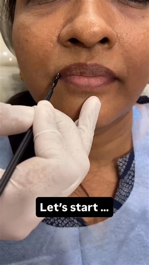 Kirubaharan Selvakumar on Instagram: "Zoom Teeth Whitening ✨ One appointment. Multiple shades brighter. At Opal Dentistry, we use advanced Zoom technology to safely lift years of stains caused by tea, coffee, and everyday life. @opal_dentistry A brighter smile is not a dream — it’s a 45-minute reality 🤍 Comment ZOOM and we’ll DM you our whitening guide!"