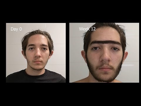 My Minoxidil SIDE EFFECTS (unwanted hair growth, itchy face, etc)