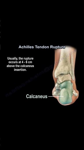 Achilles Tendon Rupture