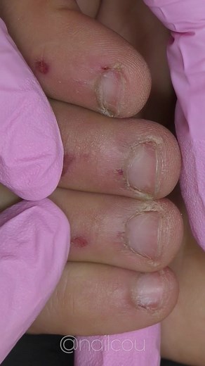 Most challenging bitten nails transformation #nailtips #nailtech #nailtechcheck #nailtechlife #nailtechbelike #bittennails #beauty #nailsalons #nailextensions #acrylicnails