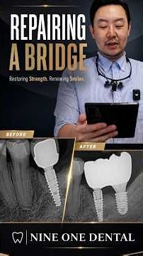 Implant Repair 🦷 Restoring Strength, Function & Confidence