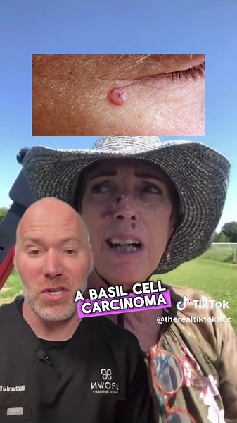 Understanding Basal Cell Carcinoma on the Nose