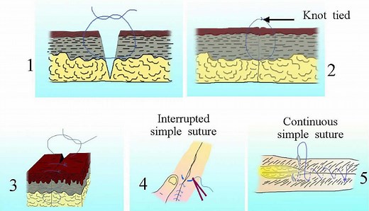 Surgical suture, types of sutures, sizes, how to suture & suture removal times