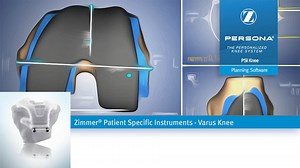 Zimmer® PSI Knee Planning -  Varus Knee