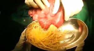 Huge Number Of Ascaris Worms Inside The Intestines