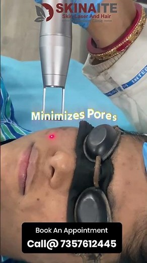 Carbon Laser Facial Treatment | The Ultimate Deep Cleansing Treatment | Skinaite Clinic