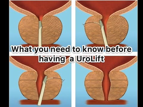 What you need to know before a UroLift procedure for the treatment of benign prostatic enlargement
