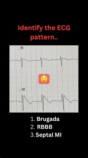 Identify the ECG pattern.. 😮🫀 #ecgquiz #cardiology #nurse #shorts #viralshorts