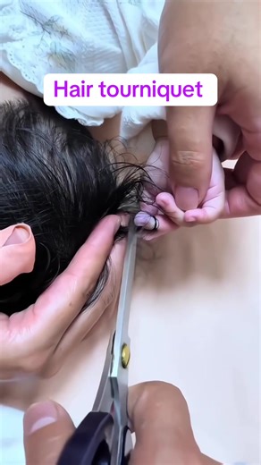 Hair tourniquet syndrome is a rare but important condition in children—most often infants—where a strand of hair or thread tightly wraps around a finger, toe, or sometimes the genitals. This constriction can cut off blood flow, leading to swelling, pain, color changes, and if not recognized early, tissue damage. It can be hard to spot because hair is thin and swelling can hide it. Signs include unexplained fussiness, persistent crying, redness, or swelling of a single digit. Prompt removal of th