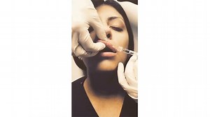 Lip Enhancement Before & After — See This Woman's Filler Injections and Results