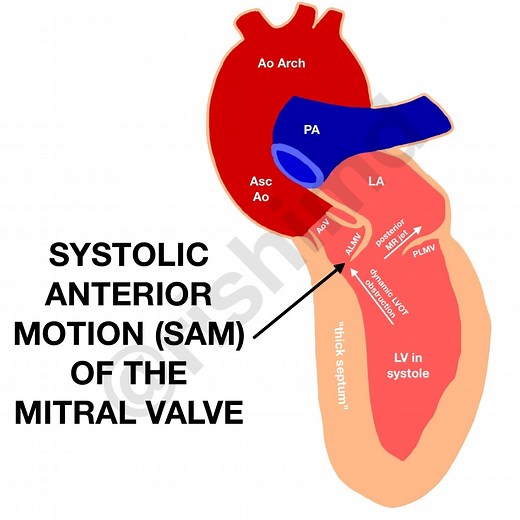 Systolic Anterior Motion (SAM) Of The Mitral Valve - Left Ventricular Outflow Tract (LVOT) Obstruction | RK.MD