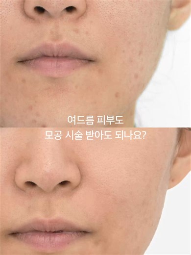 여드름 피부와 모공 시술의 모든 것