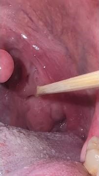 Three tonsil stones removed